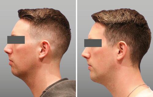 Figure 15 Before and after photos of a patient treated for chin projection. Courtesy of Sonja Sattler, MD.