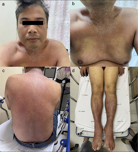 Figure 1 A 48-year-old man experiencing multiple ill-defined edematous erythematous papules and plaques, accompanied by small collarettes of desquamation on his face and neck (a), upper chest and back (b and c), and extremities (d).