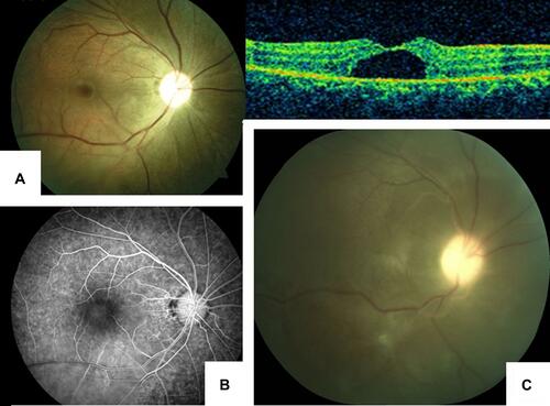Figure 7 Fundus images of a young woman who presented with exudative retinal detachment following a lightning strike. (A) Fundus photo and OCT image, 5 days following treatment. (B) Fundus fluorescein angiography (FFA) showed mild diffuse hyper fluorescence in the foveal area with no leakage. (C) Shifting fluid with retinal pigment epithelium (RPE) mottling suggestive of exudative RD.