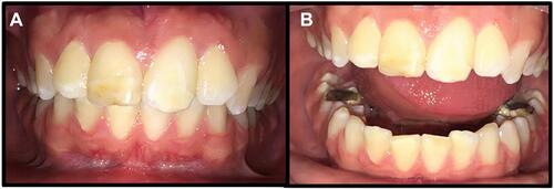 Figure 3 Dental photography (A) centric occlusion, it is evident the hyperpigmentation in the medial incisors and the generalize enamel hypoplasia. (B) Opening centric occlusion also shown the amalgam restoration of the lower molars, dental crowding in lower incisor and twisted of the upper first and second premolars.