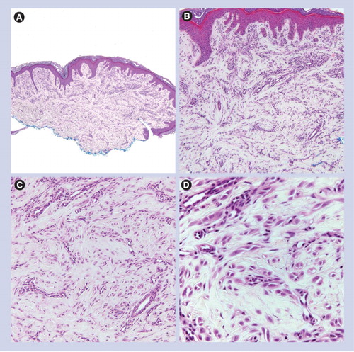 Figure 4. Angiomatoid Spitz nevus.(A) Dermal-based lesion (40×). (B & C) Spindled and epithelioid melanocytes are set in a dense fibrous stroma, associated with prominent blood vessels (100× and 200×, respectively). (D) Epithelioid/spindled melanocytes and prominent vessels (400×).