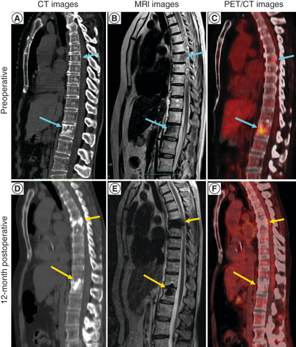 Figure 1. CT, MRI and PET imaging studies of T7 and L1. (A) CT image, without contrast, showing bone defects (blue arrows) caused by the metastatic breast tumor. Lysis due to bone destruction and loss is black while sclerotic bone due to pathologic bone formation is white. (B) T2 short tau inversion recovery (STIR) MRI image showing the lytic bone defects (blue arrows) due to the tumor. (C) PET/CT image showing the presence of tumor in the vertebral bodies (red-yellow color; blue arrows). (D) CT image, without contrast, 12 months after treatment. Radio dense bone (yellow arrows) is shown in the space treated using ZetaMet™. (E) T2 STIR MRI image of the treated defects (yellow arrows). Images show that the tumor was replaced with radio dense bone. (F) PET/CT image showing that there is no signal due to tumor in the treated defects (yellow arrows).CT: Computed tomography.