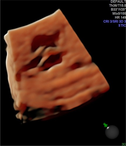 Figure 6 Spatiotemporal image correlation with HDlive in rendering mode, showing the plane of left ventricle outflow. Illumination incident at 11 o’ clock.