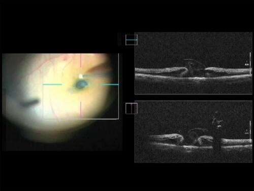 Figure 1 Multi-layers of ILM in macular hole during vitrectomy surgery with modified ILM flap technique.