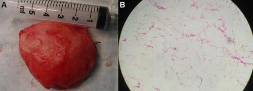 Figure 3 Clinical photograph. (A) Gross examination of specimen reveals a well encapsulated 4.3⨰4.5⨰2 cm, yellowish gray mass. (B) H&E stain shows tumor composed of lobules of mature adipocytes along with fibro collagenous septa (⨰10 magnification).