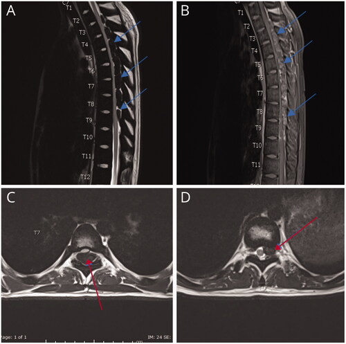 Figure 3. MRI spine: intraspinal epidural extramedullary masses T2 (lowered border) to T9 (arrows in A and B). Anterior displacement and compression of the cord in the thoracic spine is secondary to the compression by the EMH (arrow in C at T7 level) reaching upto the left neural foramen (arrow in D at T10 level). Note. Image taken from Clinical Case reports from a previously published article [Citation18]. The licence of the article (CC-BY) permits unrestricted reuse of the published work.