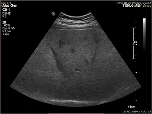 Figure 2 Moderate steatosis (S2) bright liver with obvious posterior attenuation.