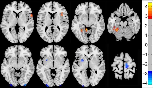 Figure 1 Brain regions showing ReHo differences in the cerebellum anterior lobe, fusiform gyrus, frontal-temporal space, middle occipital gyrus, insula, claustrum, and paracentral lobule lobe in patients with PACG compared with NCs.