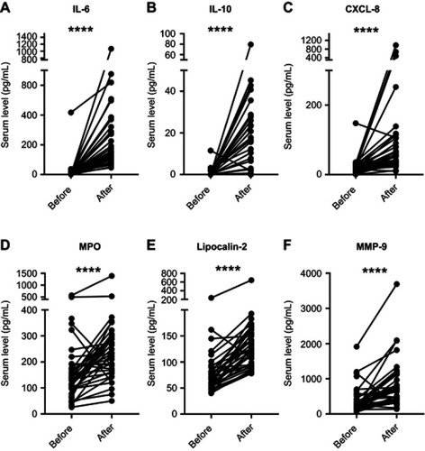 Figure 3 Circulating levels of cytokines and markers of neutrophil degranulation before and after CABG. Serum levels of (A) IL-6, (B) IL-10, (C) CXCL-8, (D) MPO, (E) lipocalin-2, and (F) MMP-9 before and after surgery. ****p<0.0001.Abbreviations: CABG, coronary artery bypass grafting; MPO, myeloperoxidase; MMP, matrix metallopeptidase.