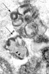 Fig. 2 Rectal mucosa. At high magnification curvilinear profiles (arrowheads) and fingerprints (arrows) are visible. TEM. Original magnification, × 40,000.