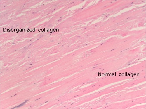 Figure 3 Normally organized collagen (lower right) and disorganized collagen showing separation, fragmentation, and disorientation of fibers (upper left of image).