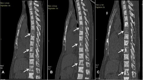 Figure 7 Spine CT showed the bone lesion remained stable before (A) and after (B and C) CDK4/6 inhibitor plus fulvestrant therapy. The lesions were annotated with white arrows.