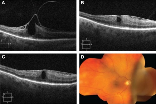 Figure 1 Vitreomacular traction (VMT) resolution, lowered intraocular pressure (IOP), and choroidal effusion after ocriplasmin injection.