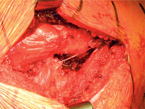 Figure 2. Pain catheter placement in hip resurfacing arthroplasty. The pain catheter is advanced to the superior apex of the wound and placed with forceps above the pyriformis tendon such that its tip lies within the capsule antero-superior to the joint. The slack is then taken up so that the catheter lies over the long axis of the wound, in the plane over the external rotator muscles