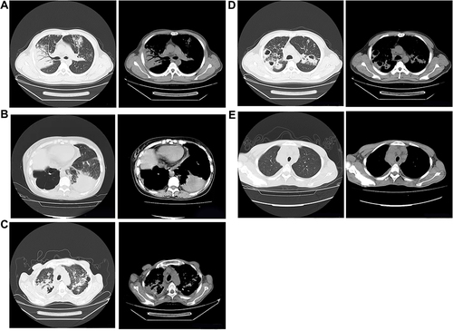 Figure 2 Chest radiograph signs in pulmonary window and mediastinal window. (A) Air bronchial sign. (B) Large segmented leafy shadow. (C) Thick-walled cavity. (D) Multiple cavities. (E) Lymph node enlargement.