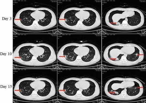 Figure 6. Chest CT scans on days 3, 10, and 15 after onset for Pt-4. CT showed scattered bilateral multiple high-density effusions with shadows along the lungs on the third day. Effusions were partially absorbed and fibrotic on day 10. Effusions were obviously absorbed and most were fibrotic on day 15. Red arrows indicate typical lesions.