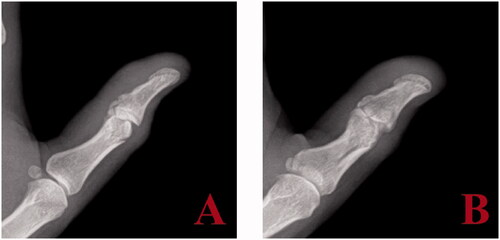 Figure 2. Plain radiograph lateral and oblique (A, B) of thumb two months post injury indicate early HO developing at the IP joint.