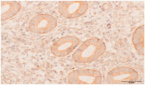 Figure 1. VDR expression in glands and stroma of eutopic endometrium – proliferative phase. IHC test × 400.