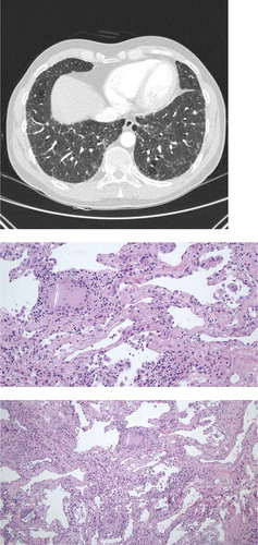 Figure 2. 51-year-old male referred for increasing dyspnea and cough. HRCT showing diffuse reticulation, ground glass opacity, traction bronchiectasies and consolidations. Cryobiopsies showing chronic inflammation, fibrosis and granulomas/giant cells. The patient was diagnosed with chronic hypersensitivity pneumonitis