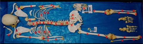 Figure 3. Illustration of the skeleton showing the locations of the injuries.