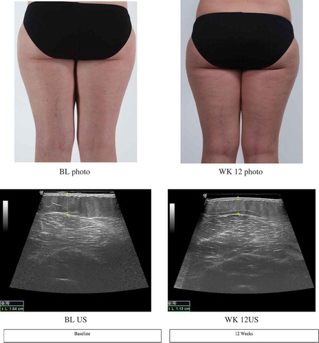 Figure 5. Visual photographic and ultrasonography images of subject A.Figure 5 Legend. Images from visual photography and ultrasonography from baseline and week 12 of Subject A (38-year-old female). Visual photography shows smoothening of skin texture and reduction of cellulite dimpling. Ultrasonography image shows reduction in subcutaneous fat tissue thickness of the thigh from baseline (1.54cm) to week 12 (1.13cm).