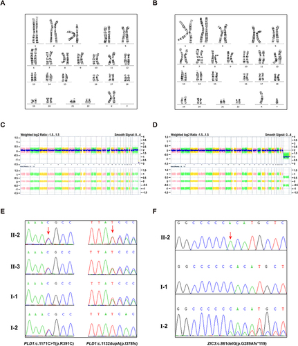 Figure 2 The genetic testing results of the two families. (A) The karyotype of family A’s proband. (B) The karyotype of family B’s proband. (C) The CMA result of family A’s proband. (D) The CMA result of family B’s proband. (E) Sanger sequencing analysis of the family A. The left panel showing the PLD1: c.1171C>T (p.R391C) variant which the region indicated by the red arrow. The right panel showing the PLD1: c.1132dupA (p.I378fs) variant which the region indicated by the red arrow. (F) Sanger sequencing analysis of the family B. Segments of genomic DNA sequences showing the ZIC3: c.861delG (p.G289Afs*119) which the region indicated by the red arrow. Upper panel: the proband’s hemizygous variant. Middle panel: wild-type of the father. Lower panel: heterozygous variant of the mother.