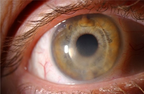 Figure 1 Slit-lamp photograph of the right eye, showing Verisyse lens implant and diffuse inferior corneal edema (case 2). Vertical enclavation was selected, because the patient had against-the-rule astigmatism, so a temporal incision would improve rather than exacerbate the astigmatism.
