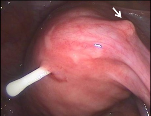 Figure 5 Secondary perforation of one extremity of the transverse arm of an intrauterine device close to the uterotubal junction; the other extremity is about to perforate (arrow).