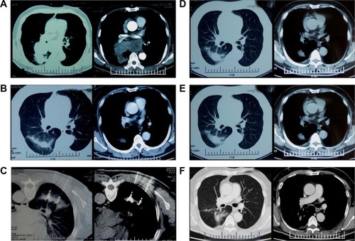 Figure 1 CT scan images taken during the entire treatment course and follow-up.