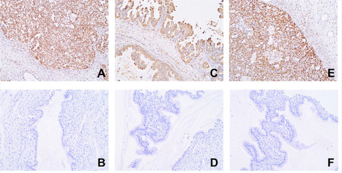 Figure 1 The expression of the three proteins in SOC and ovarian serous cystadenoma (ElivisionTM, ×400; (A) NCAPH in SOC; proportion of positive cells; (B) NCAPH in ovarian serous cystadenoma; (C) AGGF1 in SOC; (D) AGGF1 in ovarian serous cystadenoma; (E) FOXC2 in SOC; (F) FOXC2 in ovarian serous cystadenoma).