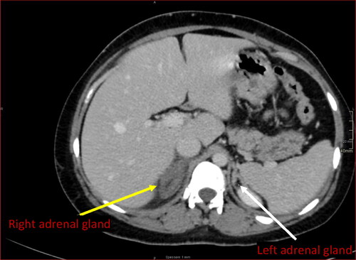 Figure 2. CT scan with contrast. CT scan displays an enlarged and edematous right adrenal gland with preserved morphology, no enhancement following intravenous contrast and inflammatory peri-adrenal fat stranding (yellow arrow). Note usual enhancement of the contralateral adrenal gland (white arrow).