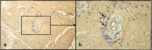 Figure 1.  Perivascular plasma cells (arrows) surrounded by amyloid deposits. Stain: Immunohistochemistry using anti-ALκ (KRA) as primary antibody and 3-amino-9-ethylcarbazole (AEC) as chromogene (ALκ and κ-chains in serum and plasmacells are stained red), counterstain with haematoxylin (blue).