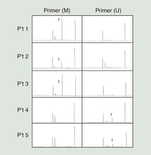 Figure 1.  Capillary electrophoresis of methylation-specific PCR for DLEC1.Gene methylation of DLEC1 was found in patients 1, 2 and 3, while patients 4 and 5 had unmethylated DLEC1. †Positive findings of methylation-specific PCR products.M: Primers for the methylated gene promoter; U: Primers for the unmethylated gene promoter.