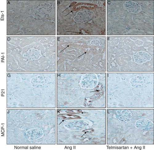 FIGURE 2. Ang II-induced tubular cell Ets-1 expression is associated with tubular cell expression of PAI-1, p21, and MCP-1. Renal cortical sections from normal saline (n = 4), Ang II (n = 4), or Ang II + telmisartan (n = 4) -receiving mice were immunolabeled for Ets-1, PAI-1, p21, and MCP-1. Representative microphotographs showed increased distal tubular cell expression of Ets-1 in Ang II-receiving mice (B) when compared with renal cortical sections from normal saline (A) and Ang II + telmisartan (C). Ang II also enhanced the distal tubular cell expression of PAI (E); however, AT1-receptor blockade attenuated this effect of Ang II (F). Similarly, Ang II increased the distal tubular cell expression of p21 (H); however, telmisartan attenuated this effect of Ang II (I). Ang II also promoted the expression of MCP-1 by distal tubular cells (K), which was inhibitied by telmisartan (L).