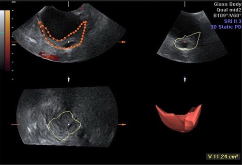 Figure 3 Virtual organ computer-aided analysis of the ovary (excluding endometrioma).