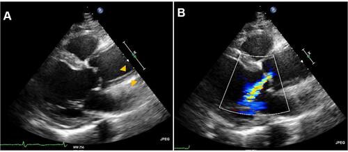 Figure 1 (A) Parasternal long axis view showing a thickened aortic wall in a patient with type A intramural aortic hematoma (arrowhead). (B) Same view with color doppler. Notice a significant aortic regurgitation.