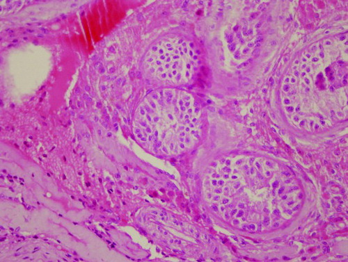 Figure 1.  Histopathological results of testis biopsies of patient 1. Testicular histology shows an apparent decrease of seminiferous tubules in testicular parenchyma. Most of the seminiferous tubules show seminiferous tubule hyalinization and Sertoli-cells only syndrome with complete absence of spermatogenetic cells (Haemotoxilin-eosin x400 magnification).