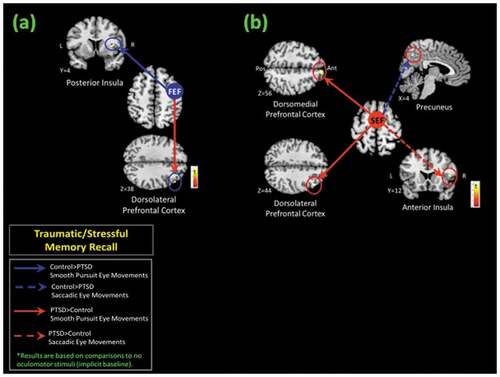 Figure 3. Explorative functional connectivity analyses (psychophysiological interaction) of (A) the right frontal eye field [FEF (x: 46, y: 0, z: 56)] and (B) the right supplementary eye field [SEF (x: 2, y: 2, z: 62)] seed regions during the traumatic memory retrieval condition. (A) During retrieval of a traumatic/stressful memory, as compared to the post-traumatic stress disorder (PTSD) patient group, healthy controls demonstrated increased right FEF connectivity with the right posterior insula with simultaneous smooth pursuit eye movements. In contrast, as compared to healthy controls, PTSD patients demonstrated increased right FEF connectivity with the right dorsolateral prefrontal cortex during retrieval of a traumatic memory with simultaneous smooth pursuit eye movements. (B) During retrieval of a traumatic/stressful memory with smooth pursuit eye movements, as compared to healthy controls, PTSD patients showed increased right SEF connectivity with the right dorsomedial and the right dorsolateral prefrontal cortices. In addition, as compared to controls, PTSD patients showed increased right SEF connectivity with the right anterior insula during retrieval of a traumatic memory with concurrent saccadic eye movements. All results are shown at pFWE ≤ 0.0125, k = 10, to correct for multiple comparisons; however, the precuneus is pFWE whole-brain corrected at p < 0.05, k = 10.