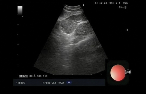 Figure 3. EUS-B image of mediastinal lymph node station 7.