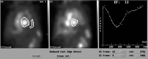 Figure 4.  MUltiple Gated Acquisition (MUGA) scan showing left ventricular ejection fraction (LVEF), end-diastolic (ED) diameter and end-systolic (ES) diameter 8 months after the start of therapy for cardiac symptoms.