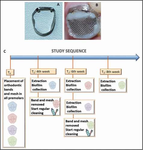 Figure 1. Study model and workflow for caries lesion initiation, progression, and arrest in vivo. Appliances used for biofilm accumulation: (A) modified orthodontic band for smooth surfaces, and (B) mesh for occlusal surfaces. (C) Study workflow