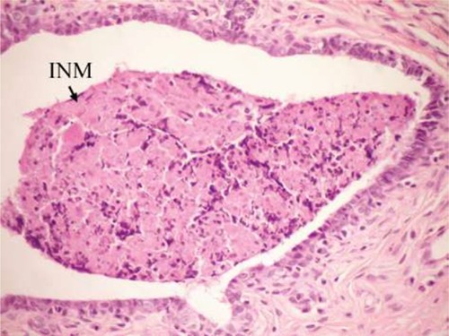 Figure 5 Photomicrograph of breast section of DMBA-administered control rat showing cystic dilatation of duct with INM (H and E, ×400).
