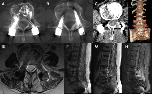 Figure 6 No abnormalities on CT and MRI 12 months after discharge (A–H).