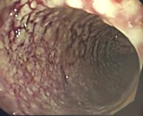 Figure 2 Endoscopic examination shows mucosal hyperemia, disappearance of vascular texture, and multiple ulcers.