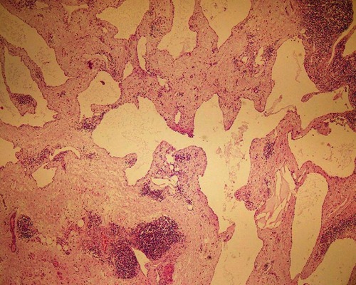 Figure 3 Microscopic section shows large and dilated lymphatic channels lined with thin endothelium and lymphoid aggregates in the septa. (H&E, ×100).