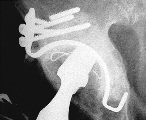 Figure 1. Broken screw in superior plate seen 37 months after surgery. The screw was known to be broken 12 months postoperatively.