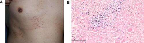 Figure 2 Skin lesions and histopathological results of patient 2. (A) Red papules along the T5-T7 dermatome on the right flank. (B) Dermis showing perivascular infiltration of eosinophils and lymphocytes. (Hematoxylin and Eosin staining - H&E, magnification: 100×).