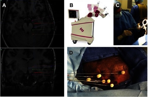 Figure 1 SEEG stereotactic planning and surgical technique. (A) Electrode trajectories are planned based on the pre-implantation hypothesis of the epileptogenic zone. We attempt to employ primarily orthogonal trajectories, avoid cortical vessels and sulci, and maximize gray matter sampling from gyral crowns, through sulcal cortex and depth of sulci, and to deep and medial targets. (B) After positioning and registration, the ROSA stereotactic robot is used to navigate to each trajectory in the operating room. (C) A small percutaneous incision and twist drill hole is made in line with the planned trajectory. (D) An anchor bolt is secured in the skull and the electrode passed to its premeasured depth and secured in the bolt. The process is repeated for each planned trajectory.