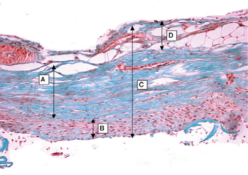 Figure 2 Illustration of a harvested periosteal flap with the different layers of interest marked. A shows fibrous layer, B shows cambium layer and C shows the total thickness of the periosteal flap. Arrow marked D shows extra tissue neither belonging to the fibrous layer nor the cambium layer (HE, ×  5).