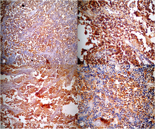 Figure 5. Photomicrographs of pituitary tissue showing (a) positive cytoplasmic staining with Thyroid Stimulating Hormone Monoclonal Antibody [TSH Immunostain x 400] (b) positive cytoplasmic staining with Adrenocorticotrophic Hormone Monoclonal Antibody [ACTH Immunostain x 400], (c) positive cytoplasmic staining with Follicle Stimulating Hormone Monoclonal Antibody [FSH Immunostain x 400] and (d) positive cytoplasmic staining with Luteinizing Hormone Monoclonal Antibody [LH Immunostain x 400].